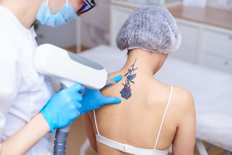 Procedimento estético pode remover completamente as tatuagens