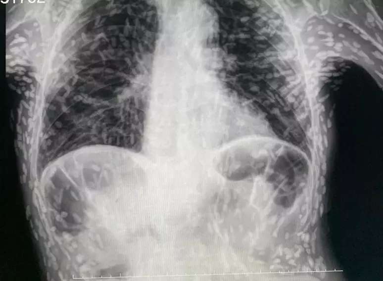 Radiografia de uma pessoa com cisticercose
