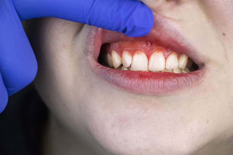 Entenda o que é a periodontite, forma agravada da gengivite