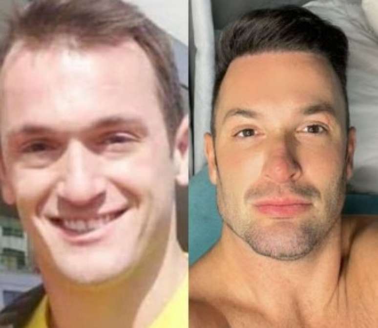 Diego Hypolito, antes e depois dos procedimentos estéticos