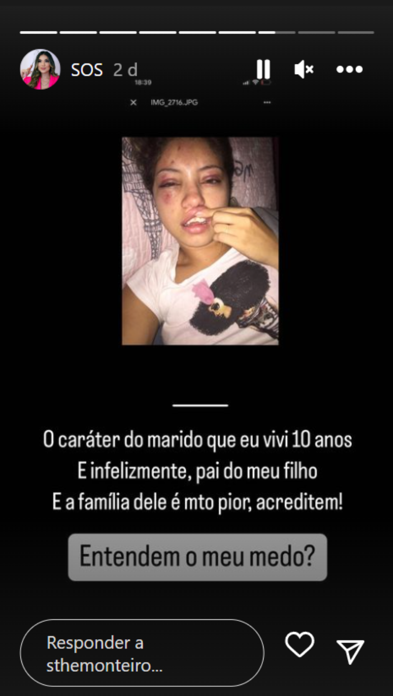 Influenciadora exp&ocirc;s foto com rosto roxo e machucado