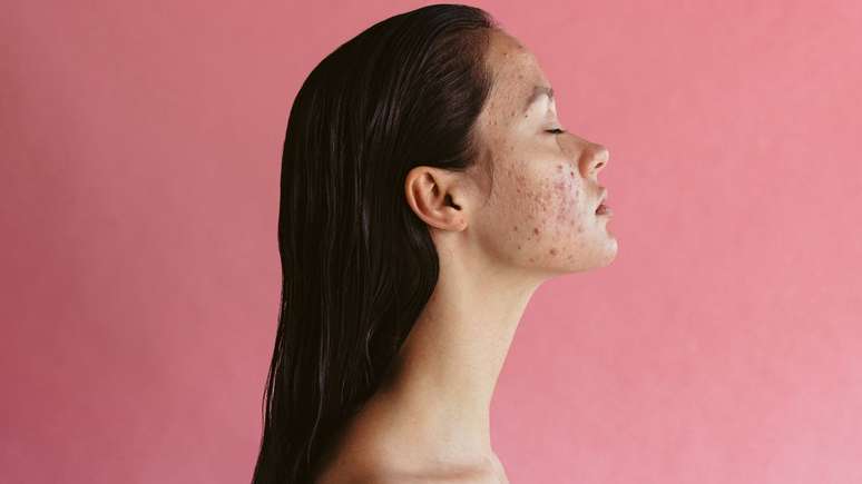 O “chip da beleza” pode causar efeitos indesejados como a acne -