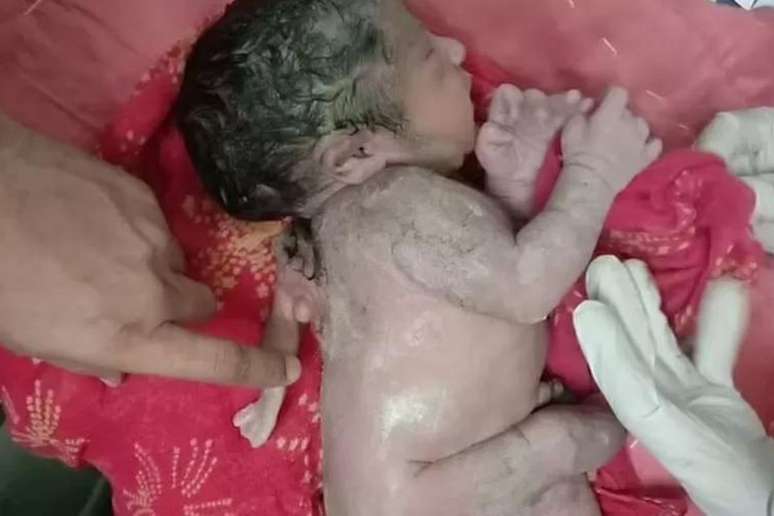 Médicos explicaram que o fenômeno do bebê que nasceu com terceira mão na Índia se chama polimelia, que é uma má