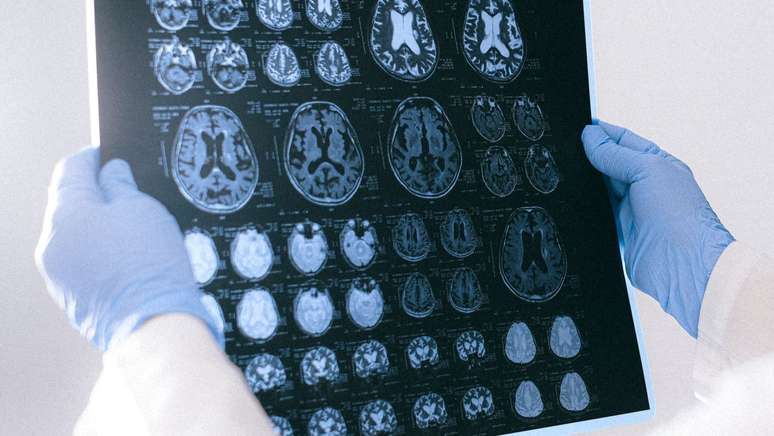 Scientists investigate mental fog and other neurological symptoms of long-term covid