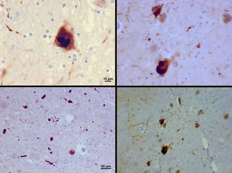 Lewy bodies, alpha-synuclein clusters present in Parkinson's patients (Image: Suraj Rajan/CC-BY-3.0) Lewy bodies, alpha-synuclein clusters present in Parkinson's patients (Image: Suraj Rajan/CC-BY-3.0)