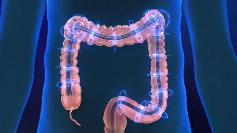 Colite microscópica só pode ser diagnosticada com uma biópsia intestinal