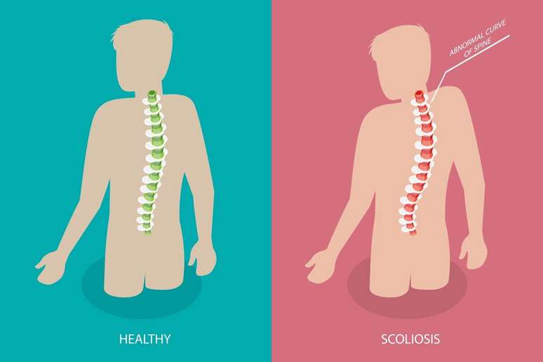 Escoliose em crianças: entenda o que é e saiba como identificar
