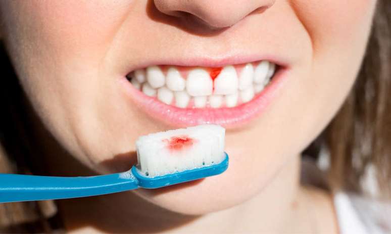 Gengiva sangrando após escovação é normal? Dentista responde -