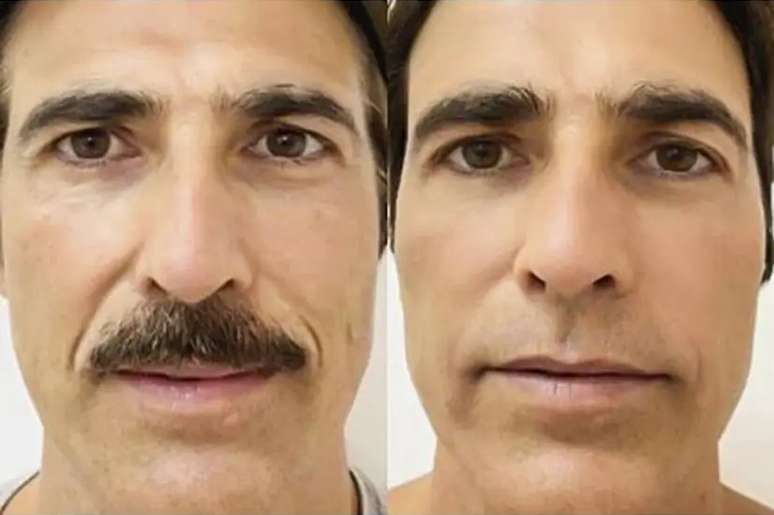 Reynaldo Gianecchini before and after collagen biostimulation.