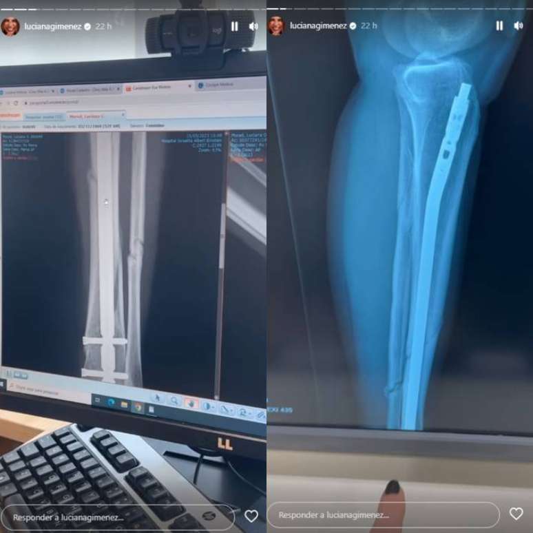 Luciana Gimenez shares the evolution of a serious leg fracture Luciana Gimenez shares the evolution of a serious leg fracture