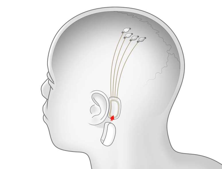 Neuralink, de Musk, iniciará teste de implante cerebral