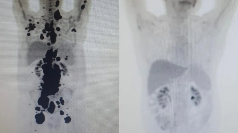 Exames mostram antes e depois de câncer de Pelegrino