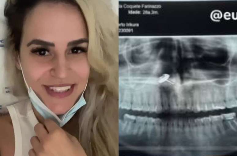 Fernanda discovered an earring inside her nostril during an exam