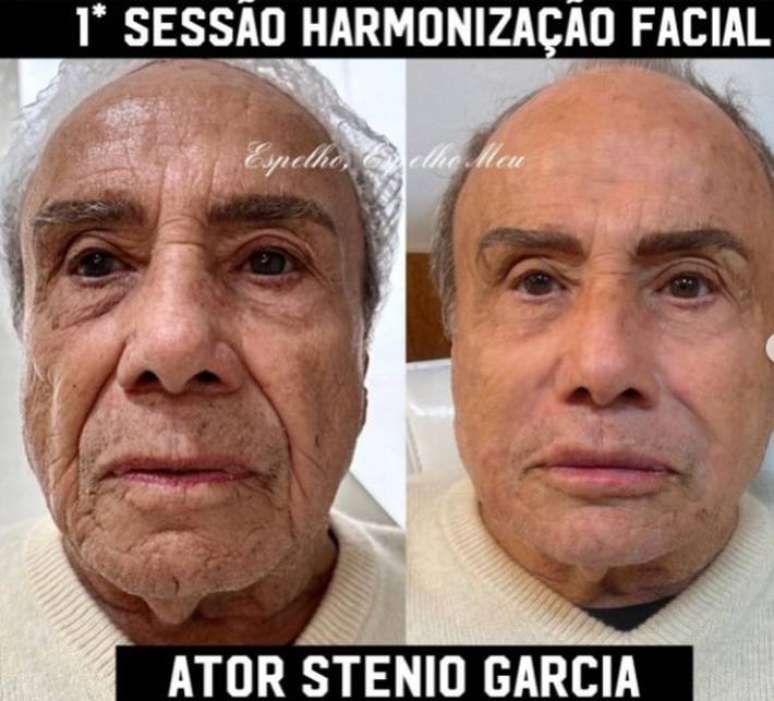 Stênio Garcia seria a pessoa mais velha a fazer harmonização facial no Brasil