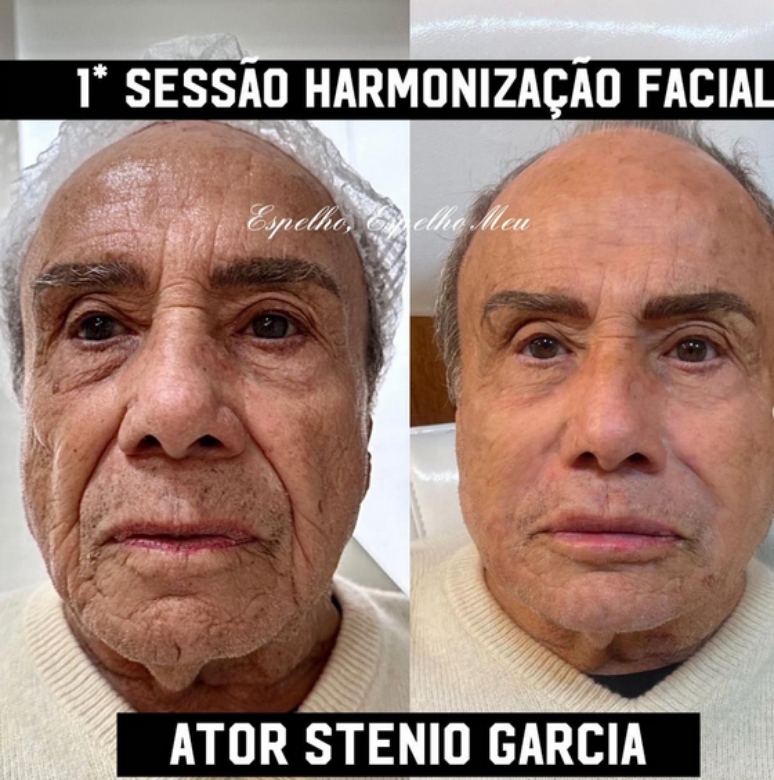 Antes e depois da harmonização facial do ator Stênio Garcia