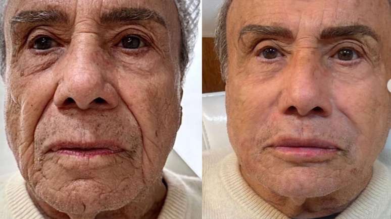 Stenio Garcia counters the criticisms and reveals the real reason for having done facial harmonization