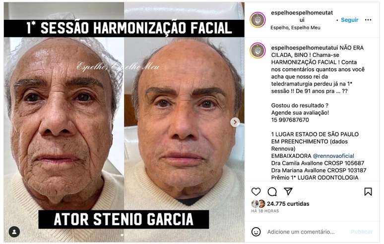 Antes e depois registrado pela clínica responsável pela harmonização facial de Stenio Garcia