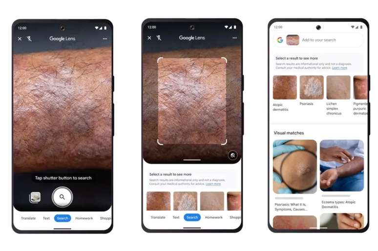 Google Lens pode ajudar pacientes a identificar doenças de pele