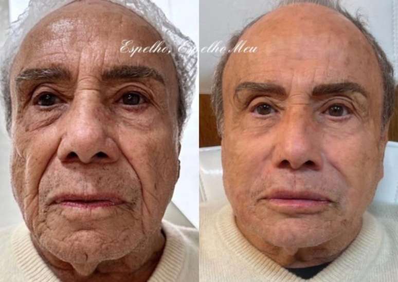 Steni Garcia antes e depois da harmonização facial