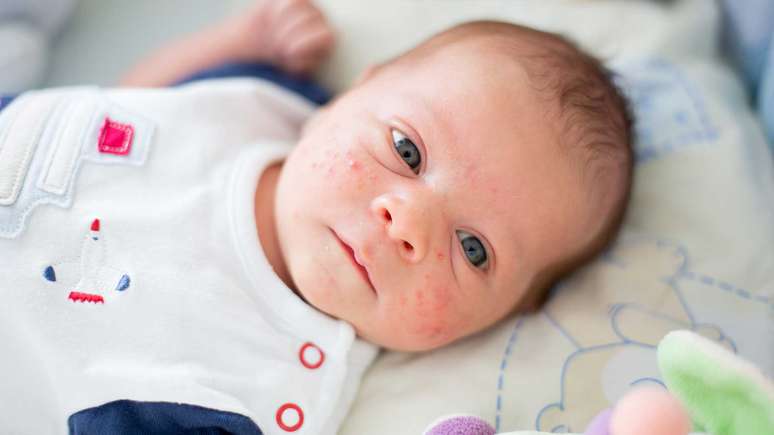 Heat rash in infants and children: why it appears and how to treat it
