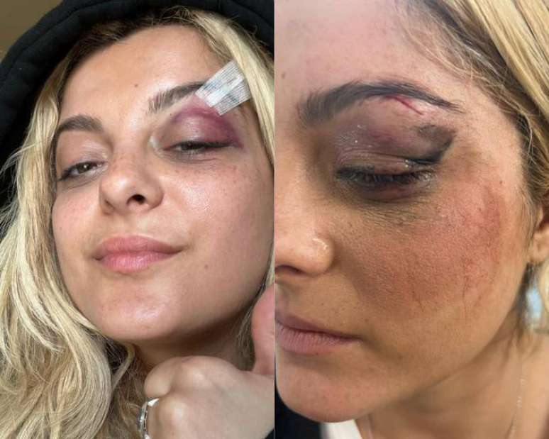 Bebe Rexha mostrou o estado de seu rosto após ser atingida por celular em show.