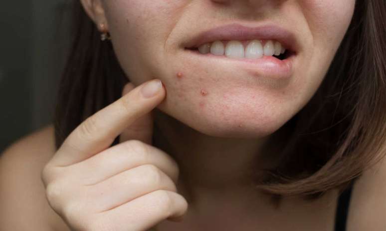 Vitamina B12 pode agravar acne; saiba quais alimentos têm o nutriente -