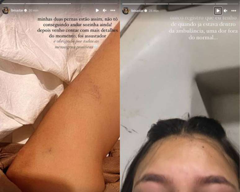 Brisa Star posta foto com perna machucada ap&oacute;s acidente na estrada; veja imagens