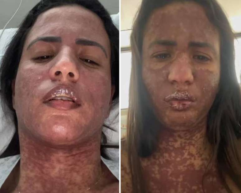 Caroline Aguiar showed photos of what she looked like with the spots scattered across her body Caroline Aguiar showed photos of what she looked like with the spots scattered across her body