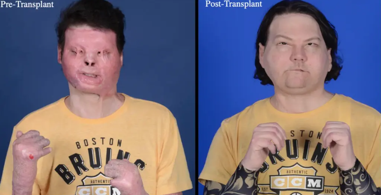 Joe DiMeo antes e depois do transplante