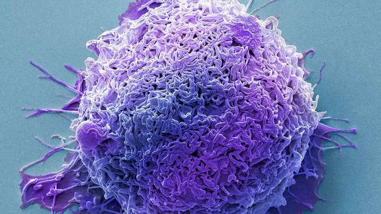 Muitas das bact&eacute;rias associadas ao c&acirc;ncer colorretal podem trabalhar juntas para piorar a condi&ccedil;&atilde;o do paciente