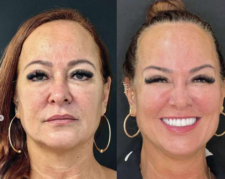 Nadine, m&atilde;e do Neymar, realizou em outubro de 2022 um procedimento conhecido como protocolo de rejuvenescimento, que consiste na aplica&ccedil;&atilde;o de fios de PDO nos c&iacute;lios, preenchimento com &aacute;cido hialur&ocirc;nico em pontos estrat&eacute;gicos, bioestimuladores de col&aacute;geno e toxina botul&iacute;nica