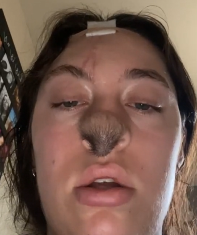 Nariz de jovem com pele enxertada come&ccedil;ou a ter 'cabelo' nos EUA