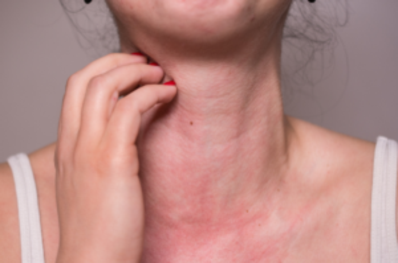 Allergies: the skin occurs in 80% of allergic cases