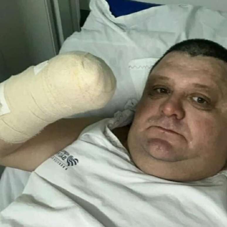 The comedian has his hand amputated after a fireworks accident