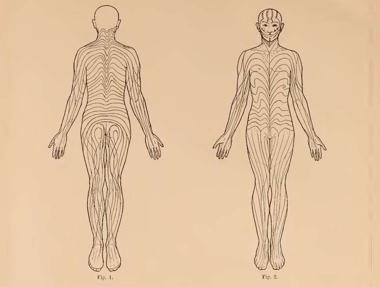 O diagrama das linhas dos nevos, 'a quintessência' da obra de Blaschko