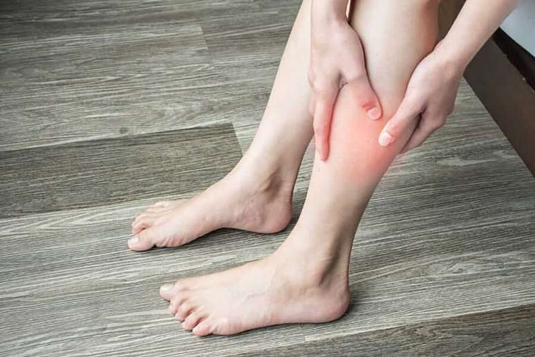 Post-workout purple spots could be signs of varicose veins