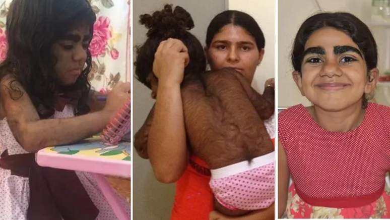 Kemilly Vit&oacute;ria tem s&iacute;ndrome rara; entenda