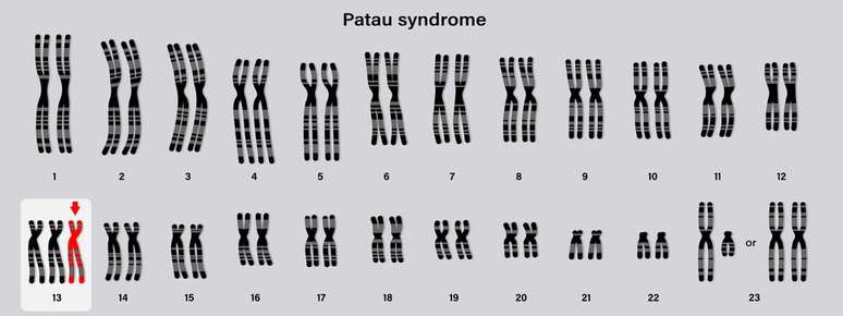 Na síndrome de Patau, há um 13º cromossomo a mais, o que gera uma série de repercussões à saúde