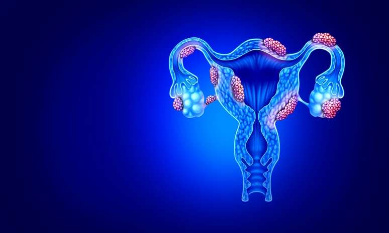 Endometriose pode ser causada por bactérias, revela estudo -