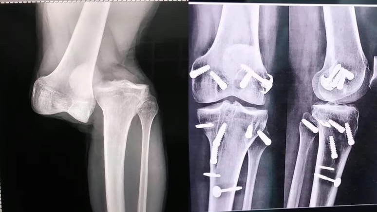 Portal divulga antes e depois de joelho de atleta lesionado por Marcelo na Libertadores