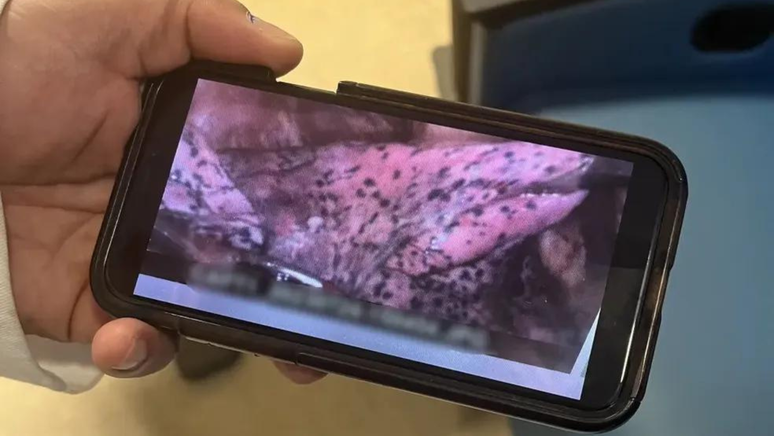 O pulmão do jovem Sean Tobin ficou cheio de manchas pretas