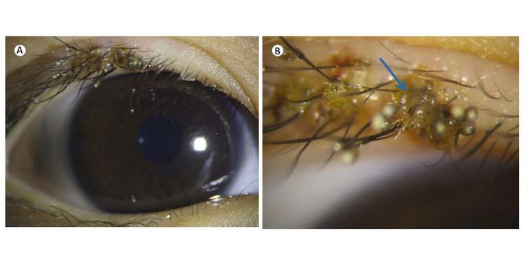 Imagens dos c&iacute;lios do garoto chin&ecirc;s, com piolhos