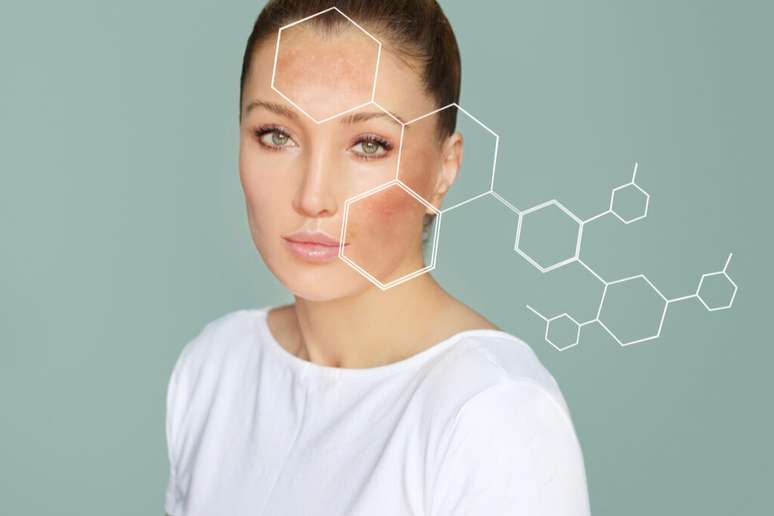 O melasma costuma acometer a região da face 