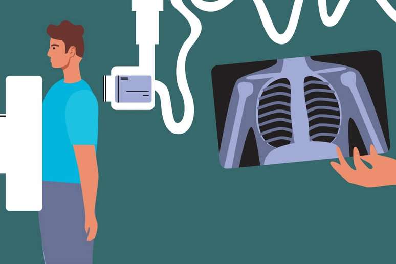 Radiografia e tomografia do tórax são usadas para diagnosticar a tuberculose 