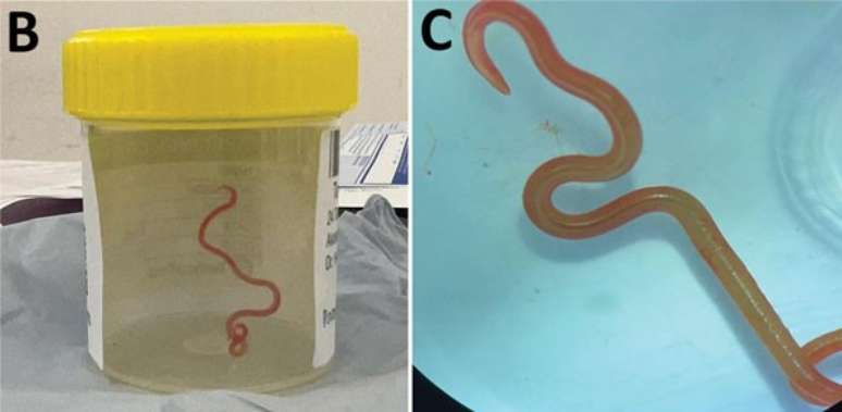 Verme foi retirado vivo de cérebro de idosa