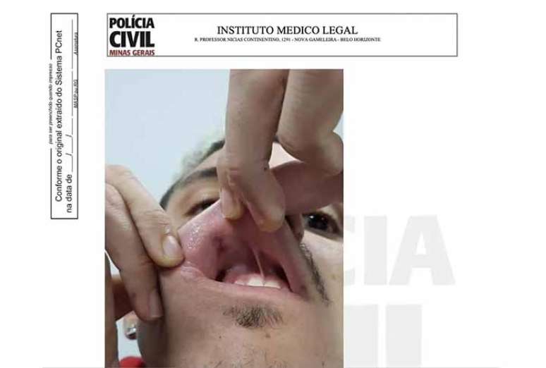 Ferimento de Pedro na boca ap&oacute;s soco do ex-preparador f&iacute;sico do Flamengo &ndash;