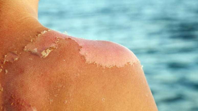 A pele lesionada pelo sol libera substâncias que contribuem para as inflamações sistêmicas, aumentando o risco de quase todas as doenças do envelhecimento