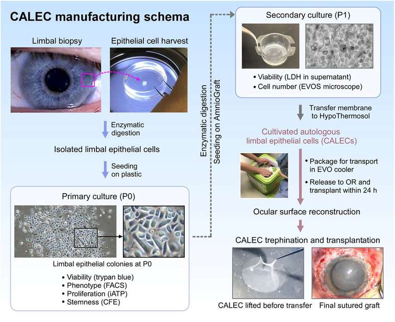 Infográfico mostrando todo o processo de tratamento, desde coleta e cultivo de células-tronco a partir de biópsia do olho saudável até o enxerto no olho doente (Imagem: Jurkunas et al./Science Advances)