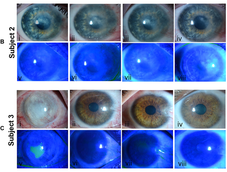 Dois pacientes que receberam o tratamento com células-tronco enxertadas, mostrando grande melhora — um deles sequer precisou de transplante de córnea (Imagem: Jurkunas et al./Science Advances)