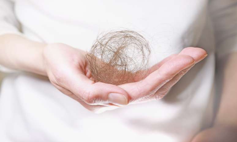 Alopecia atinge 42 milhões de brasileiros; veja como tratar -
